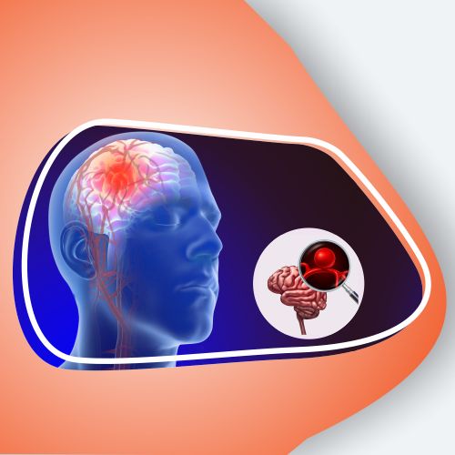 Brain Aneurysm Treatment in luckno